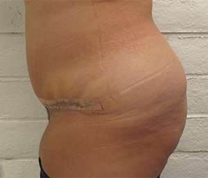 Tummy Tuck Before & After Patient #10563