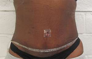 Tummy Tuck Before & After Patient #10566