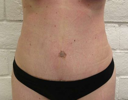 Tummy Tuck Before & After Patient #10569