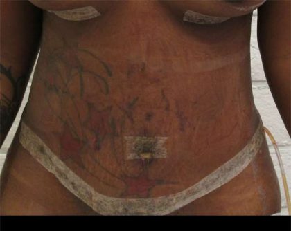 Tummy Tuck Before & After Patient #10572