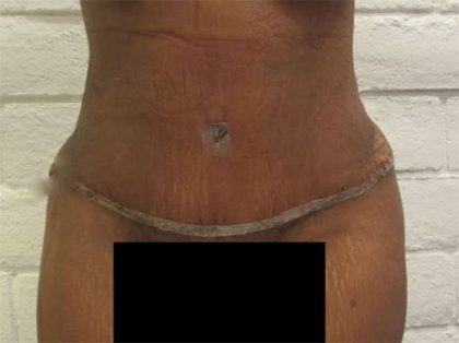 Tummy Tuck Before & After Patient #10575