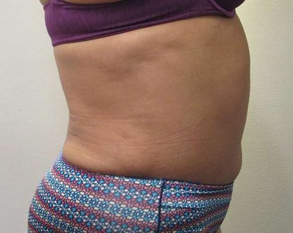 Tummy Tuck Before & After Patient #10585