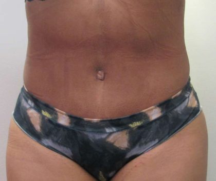 Tummy Tuck Before & After Patient #10588