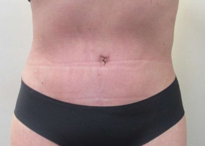 Tummy Tuck Before & After Patient #10591