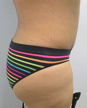 Tummy Tuck Before & After Patient #10597
