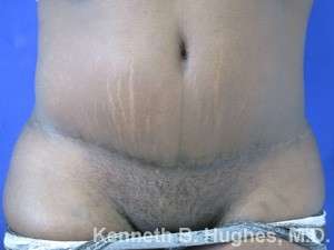 Tummy Tuck Before & After Patient #10604