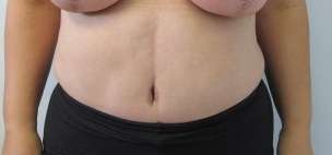Tummy Tuck Before & After Patient #10607