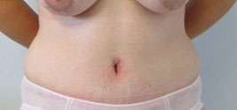 Tummy Tuck Before & After Patient #10610