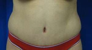 Tummy Tuck Before & After Patient #10613