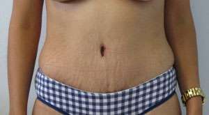 Tummy Tuck Before & After Patient #10616