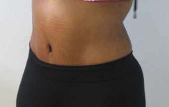 Tummy Tuck Before & After Patient #10619
