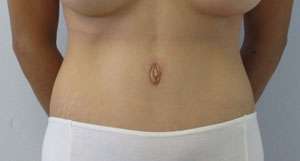Tummy Tuck Before & After Patient #10625