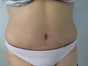 Tummy Tuck Before & After Patient #10628