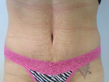 Tummy Tuck Before & After Patient #10631