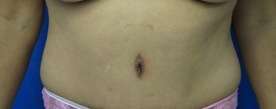 Tummy Tuck Before & After Patient #10634
