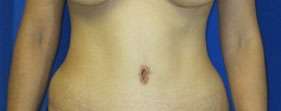 Tummy Tuck Before & After Patient #10639