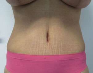 Tummy Tuck Before & After Patient #10645