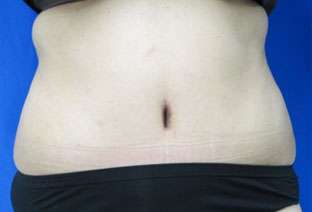 Tummy Tuck Before & After Patient #10648