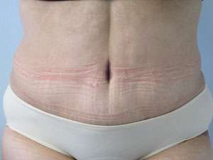 Tummy Tuck Before & After Patient #10651