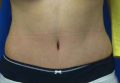 Tummy Tuck Before & After Patient #10654