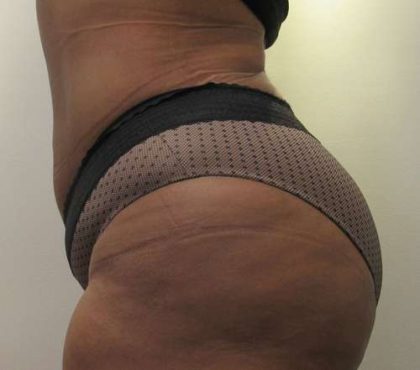 Abdomen Before & After Patient #5886