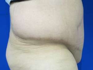 Tummy Tuck Before & After Patient #10660