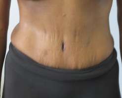 Tummy Tuck Before & After Patient #10663