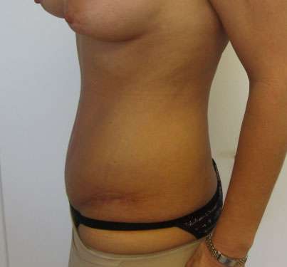Tummy Tuck Before & After Patient #10666