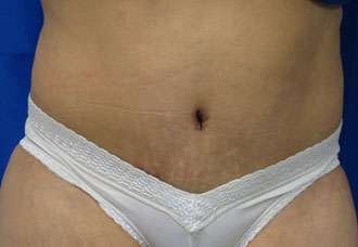 Tummy Tuck Before & After Patient #10669