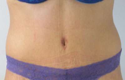 Tummy Tuck Before & After Patient #10672