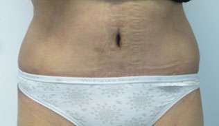 Tummy Tuck Before & After Patient #10675