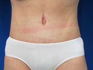 Tummy Tuck Before & After Patient #10678