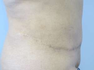 Tummy Tuck Before & After Patient #10681
