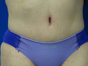 Tummy Tuck Before & After Patient #10684