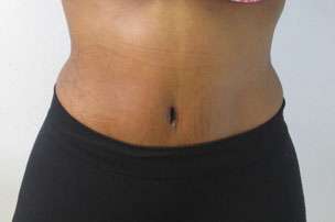 Tummy Tuck Before & After Patient #10687