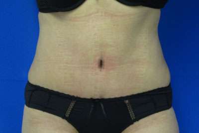 Tummy Tuck Before & After Patient #10690