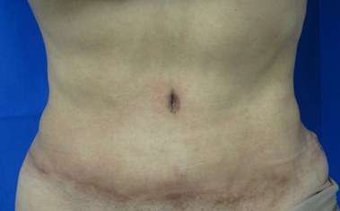 Tummy Tuck Before & After Patient #10693