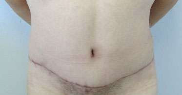 Tummy Tuck Before & After Patient #10696