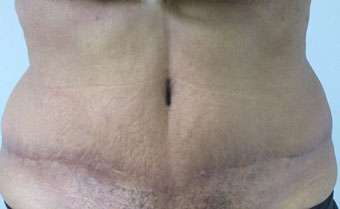 Tummy Tuck Before & After Patient #10699