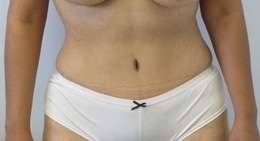 Tummy Tuck Before & After Patient #10708