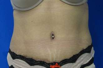 Tummy Tuck Before & After Patient #10711