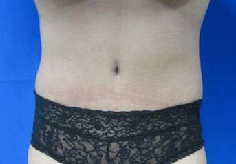 Tummy Tuck Before & After Patient #10714