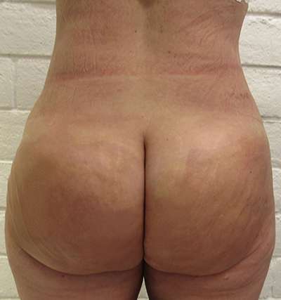 Brazilian Butt Lift Before & After Patient #6403