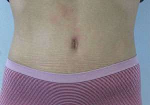 Tummy Tuck Before & After Patient #10717