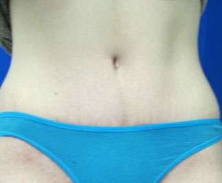 Tummy Tuck Before & After Patient #10720