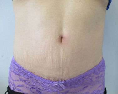 Tummy Tuck Before & After Patient #10723