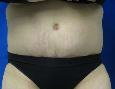 Tummy Tuck Before & After Patient #10726