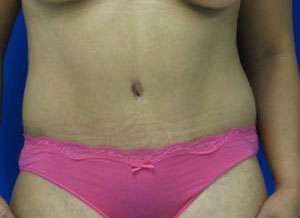 Tummy Tuck Before & After Patient #10729