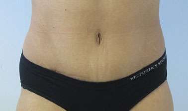 Tummy Tuck Before & After Patient #10732