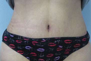Tummy Tuck Before & After Patient #10737